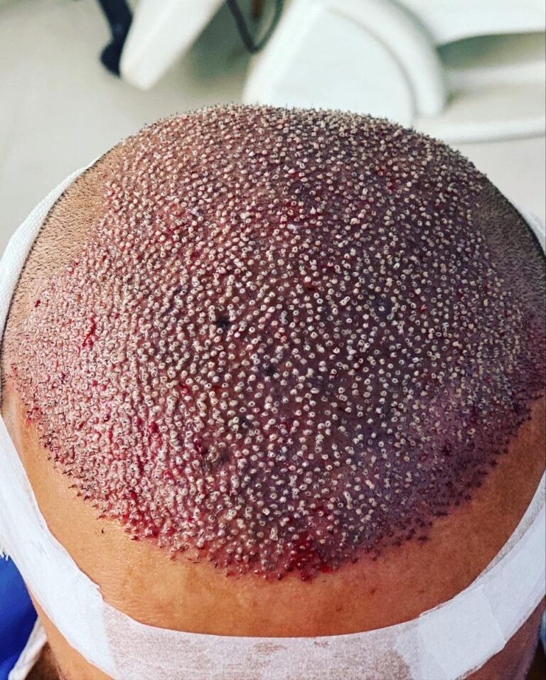 Hair Transplant Cost vs Quality: Islamabad Clinics Review