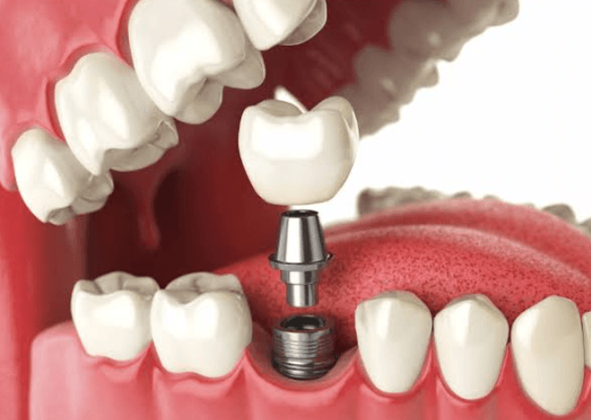 3 Common Myths About Oral Surgery And Dental Implants